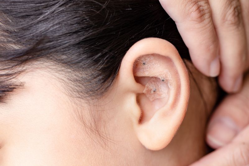 Auriculoterapia